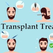 Hair Transplant in Rajkot – Best Hair Transplant Centre in Rajkot