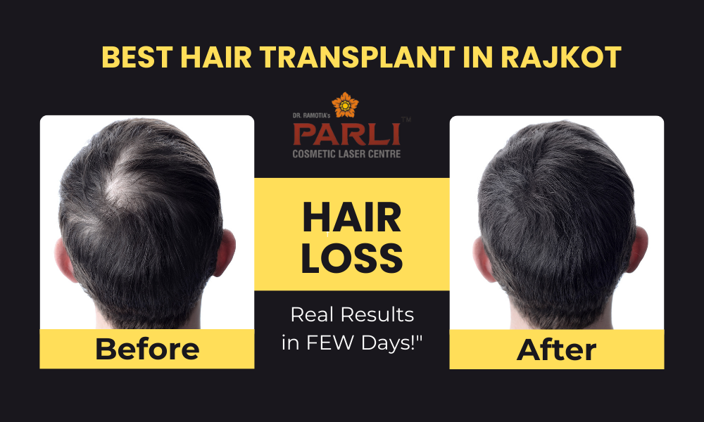 Hair Transplant in Rajkot Expert Permanent Hair Transplant Treatment by Specialists